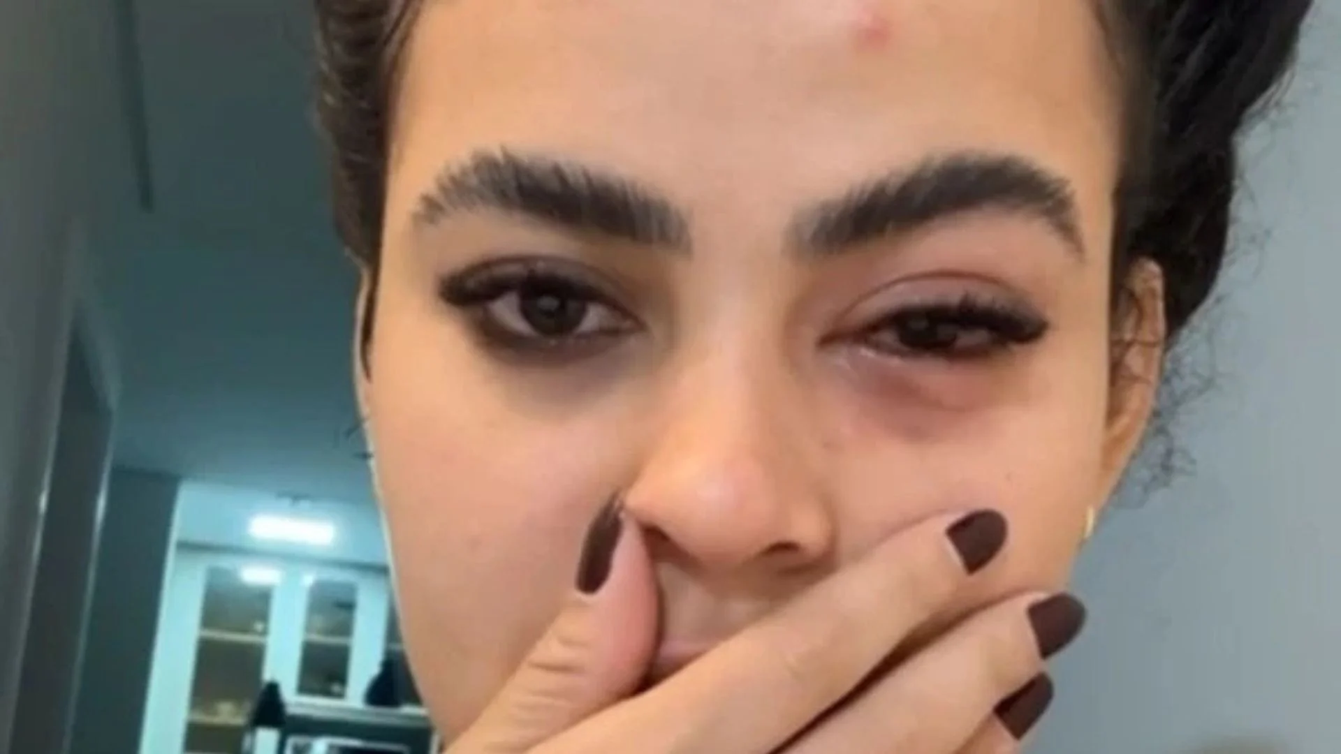 Mosca de banheiro provoca infecção ocular em influenciadora da Serra e história ganha repercussão